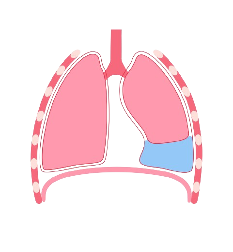 Pleural Effusion
